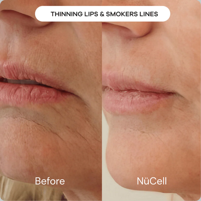 The Micro-Infusion Treatment Kit