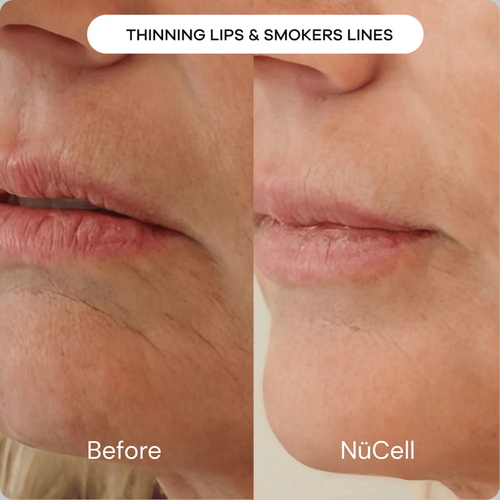 The Micro-Infusion Treatment Kit