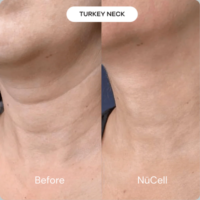 The Micro-Infusion Treatment Kit